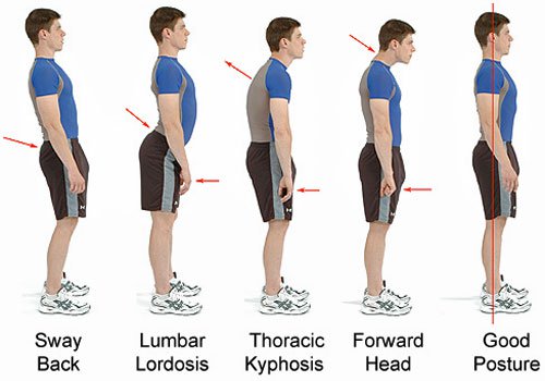 Body posture, part 1: Sway back